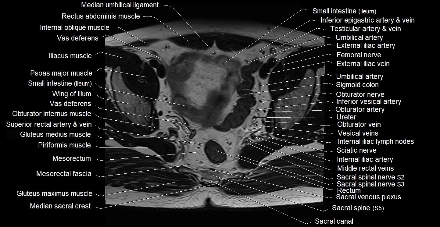 Male pelvis axial cross sectional anatomy image 18.webp
